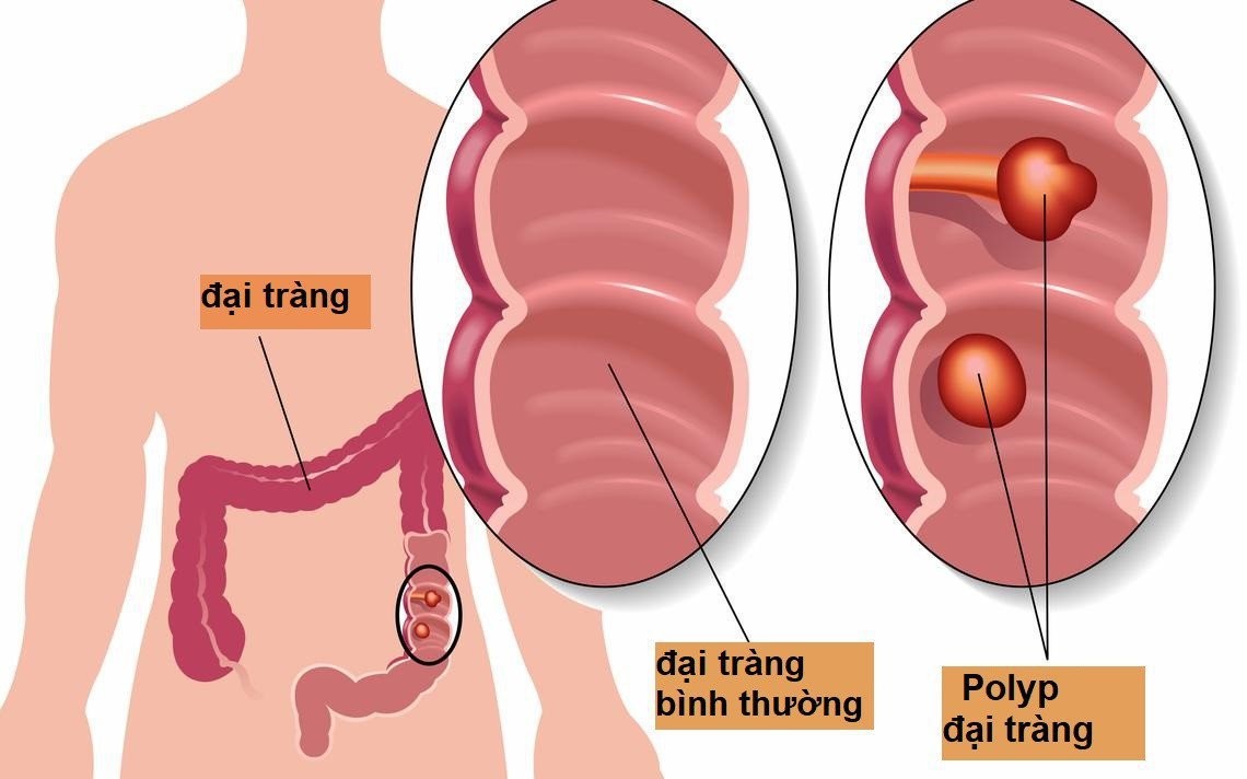 Nguyên nhân ung thư đại trực tràng - Những điều bạn thường hỏi bác sĩ